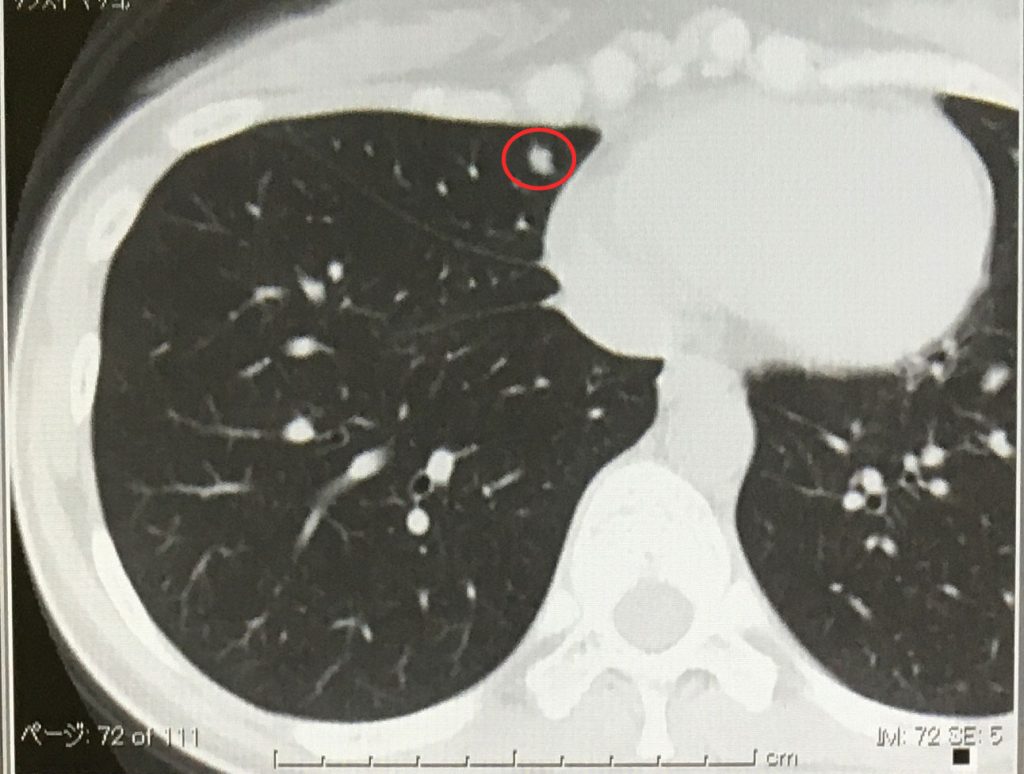 腺様嚢胞癌の肺転移画像