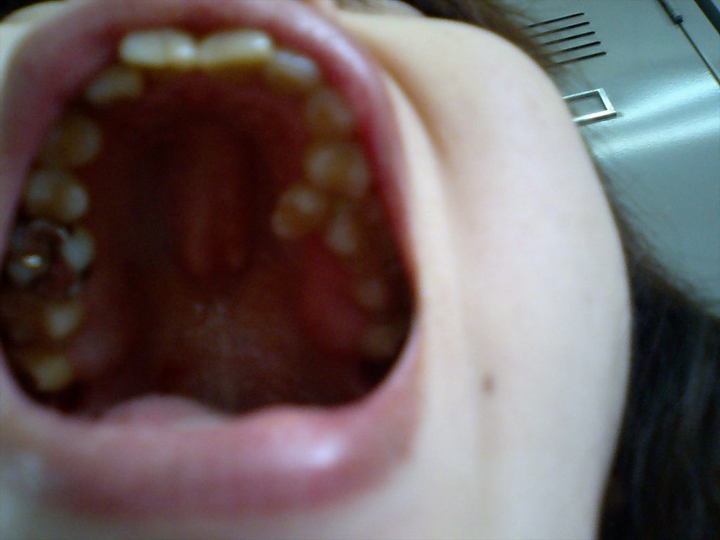 歯並びが悪いと舌がんに