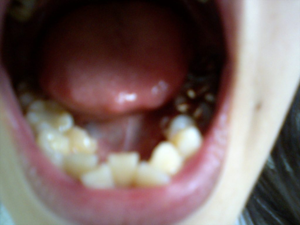 歯並びが悪いと舌がんに